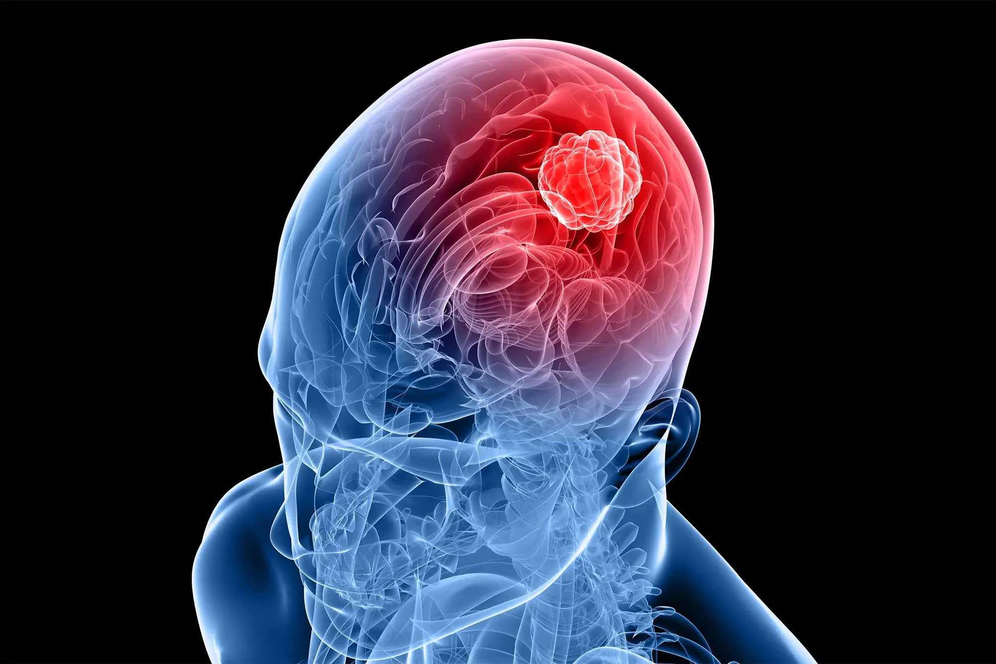 Drug Fights Brain Tumors?