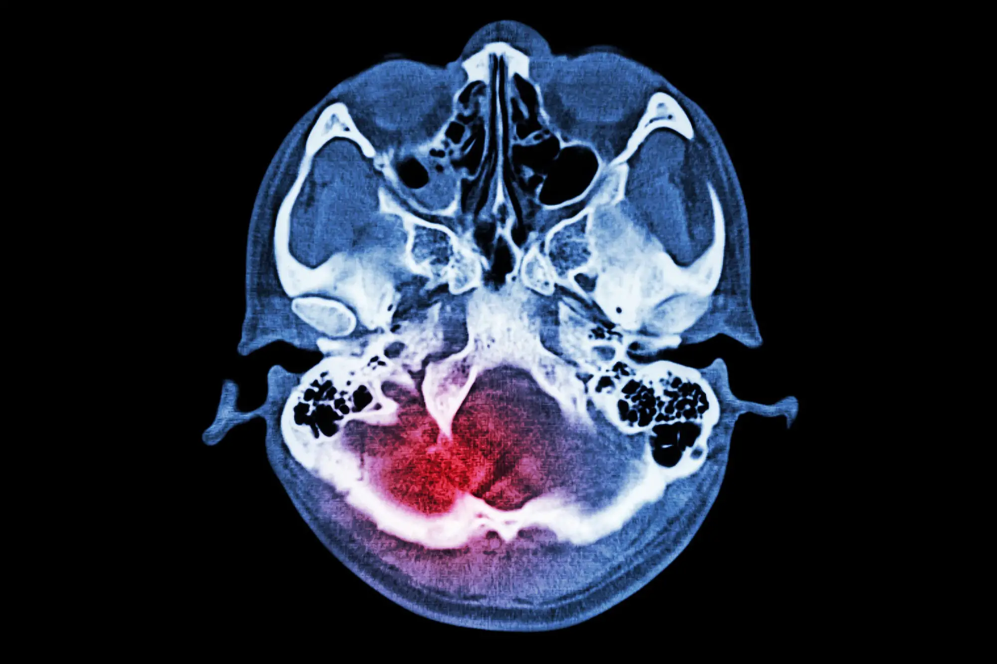 Stroke Risk Factors & Aging