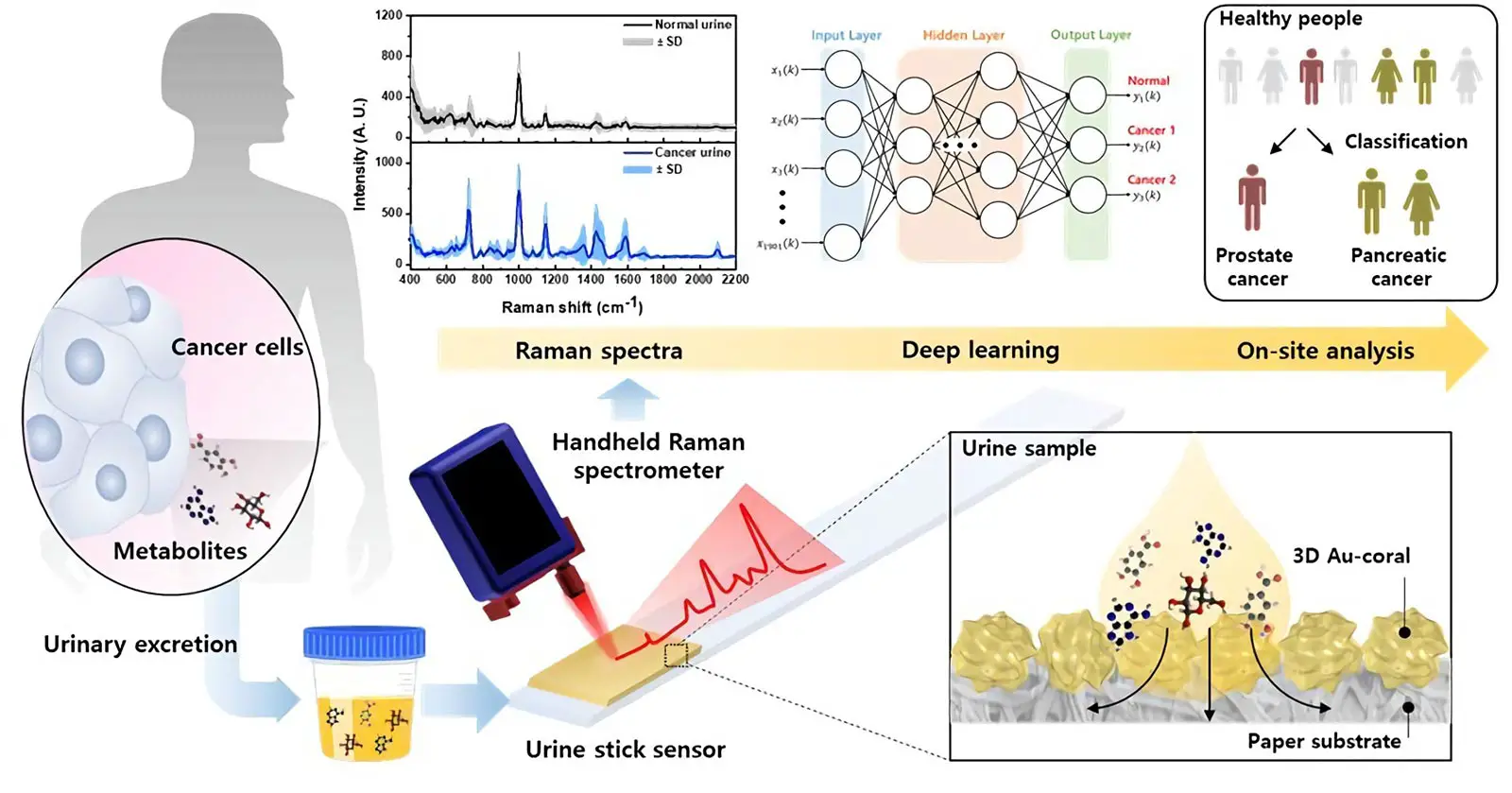 Urine Test Detects Cancer: New Sensor