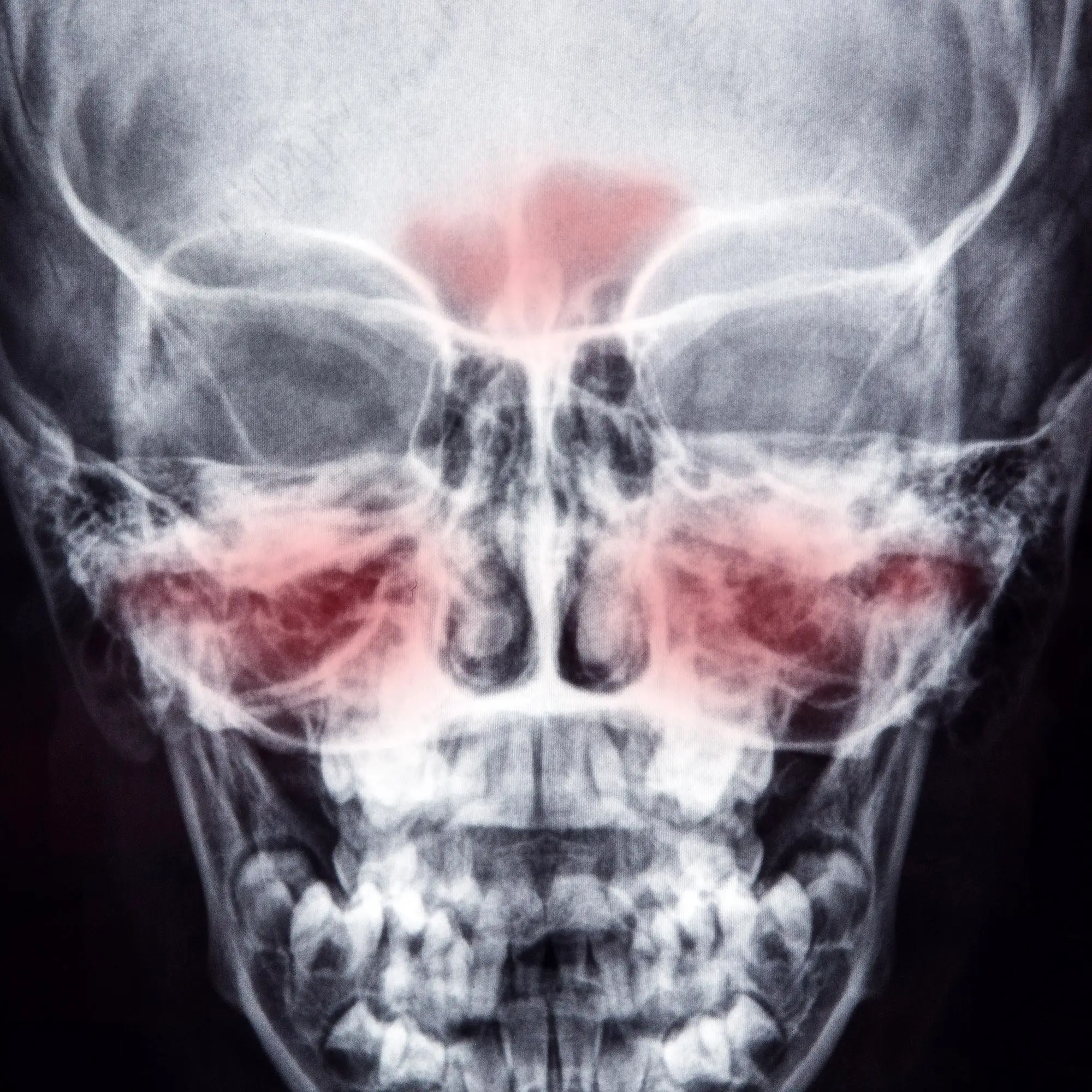 Incorrect Diagnosis of Nasal Damage as Uncommon Ailment