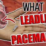 Leadless Pacemakers: What Are They?