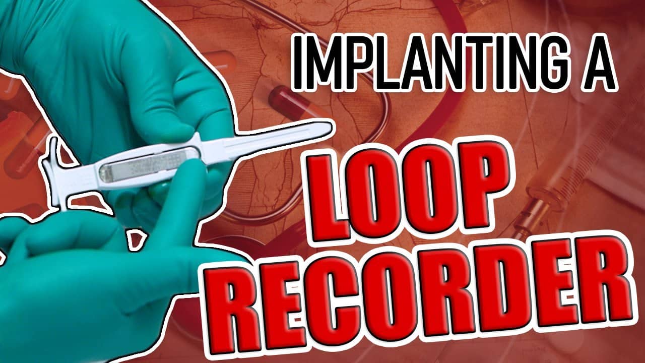 Loop Recorder Implant: A Procedure