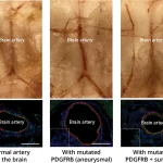 Unveiling the Mutant Genes of Brain Aneurysms