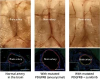 Unveiling the Mutant Genes of Brain Aneurysms