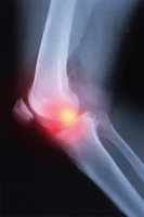 Study Questions Osteoarthritis Treatment Effectiveness