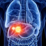 Liver Cancer Study Reveals Hidden Hero