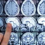 New Drug Slows Fatal Brain Cancer