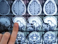 New Drug Slows Fatal Brain Cancer