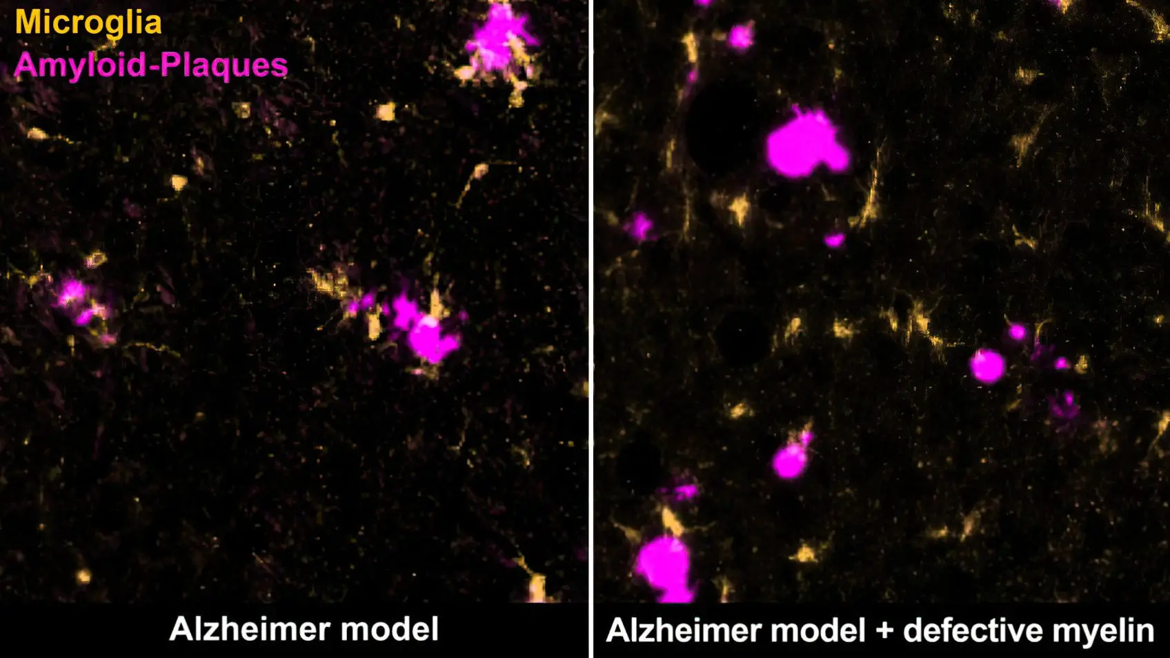 Preventing Disease through Myelin Degradation Treatment