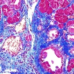 Fatal Protein Linked to Pancreatic Cancer