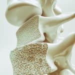 Common Osteoporosis Tool Found Ineffective