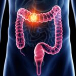 Key Symptoms of Rising Colorectal Cancer Revealed by Mayo Clinic