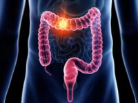 Key Symptoms of Rising Colorectal Cancer Revealed by Mayo Clinic