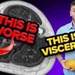 Myosteatosis: Up to 10x More Harmful Than Belly Fat – Solutions