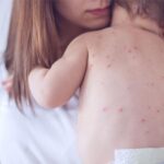 Measles Surge: Doctors Warn of U.S. Resurgence