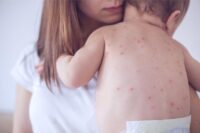 Measles Surge: Doctors Warn of U.S. Resurgence