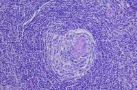 New Castleman Disease Subtype Discovered After 45 Years