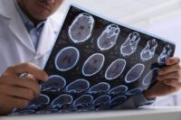 Could Recharging Brain Cells Treat MS?