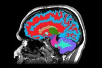 MRI Decodes Brain Clock to Predict Dementia Early