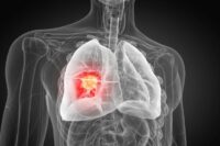 AI Quickly Identifies Hidden Lung Tumors Missed by Doctors