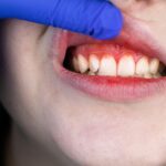 Natural Plant Compound May Aid in Gum Disease Treatment
