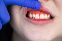 Natural Plant Compound May Aid in Gum Disease Treatment