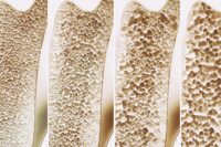 Newly Discovered Bone Switch May Halt Osteoporosis