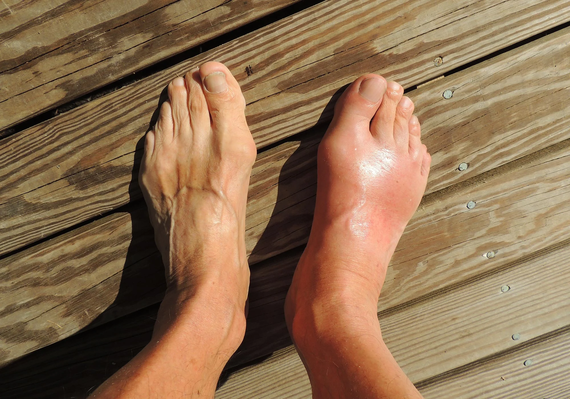 Ancient Human Gene Revived: Potential Cure for Gout