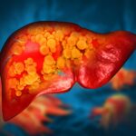 The Sugar Link Between Alcohol Addiction and Liver Damage