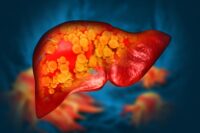 The Sugar Link Between Alcohol Addiction and Liver Damage