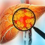 Mayo Clinic Finds Genetic Insight Challenging Liver Disease Norms