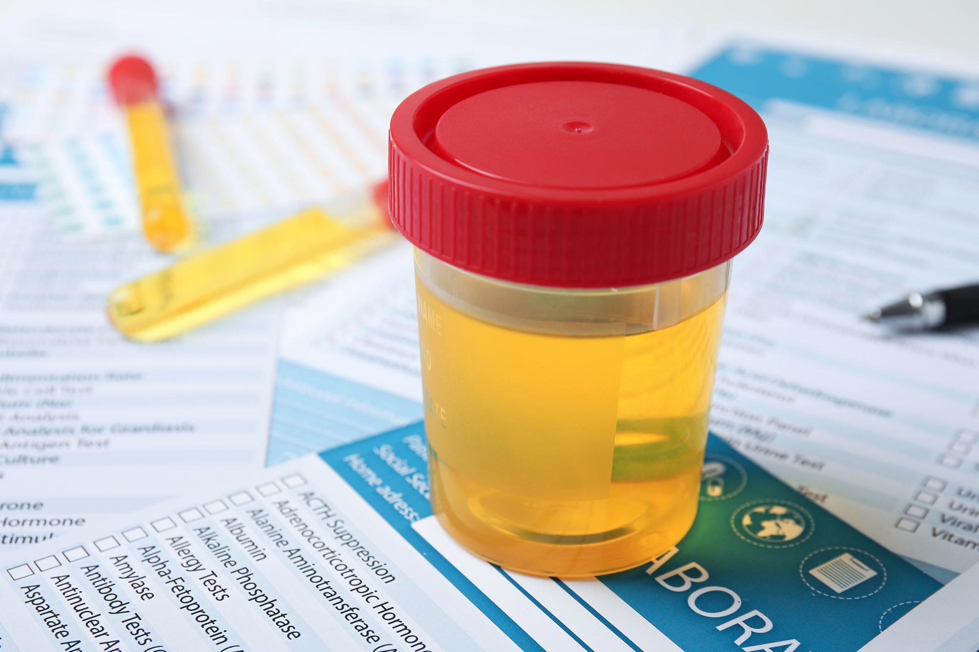 Revolutionary Urine Test for Bladder Cancer Diagnosis and Treatment