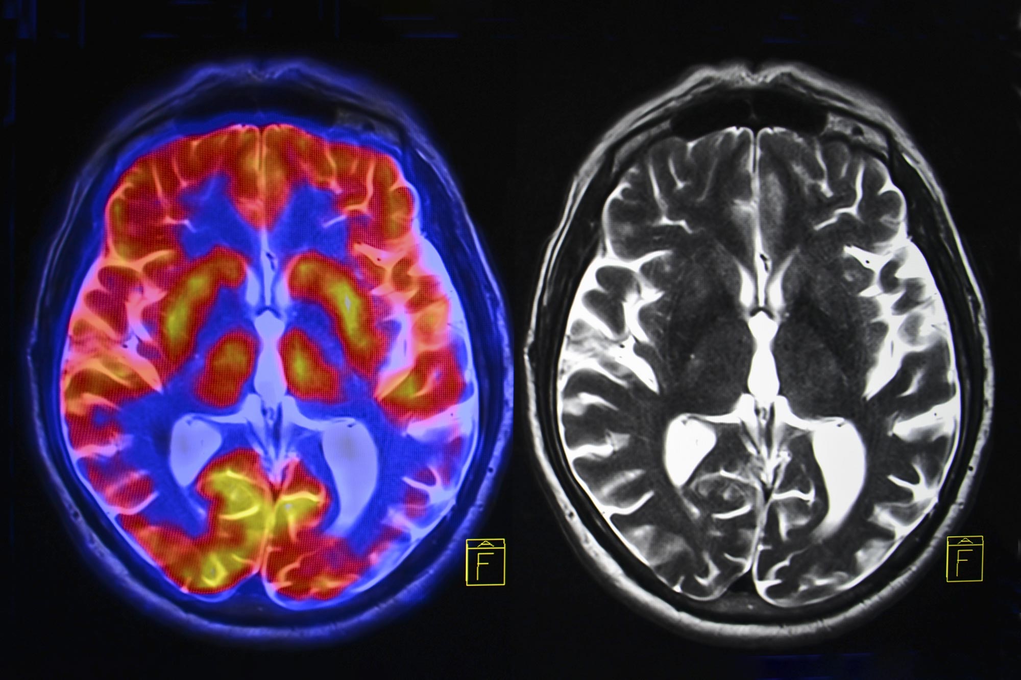 Brain Scans Show Changes Post-Menopause