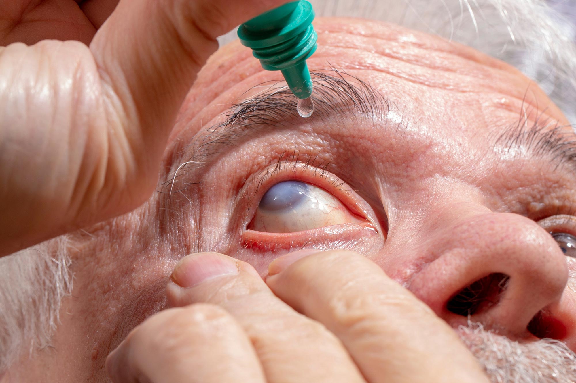 Doctors Caution: Popular Eye Ointment May Harm Glaucoma Implants