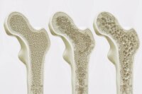 Breakthrough Bone Discovery May Enable ‘Exercise-in-a-Pill’ for Osteoporosis