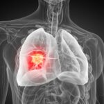 How Inflammation Boosts One of the Most Lethal Cancers