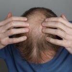 Ancient Chinese Herb Offers Hope for Common Hair Loss Treatment