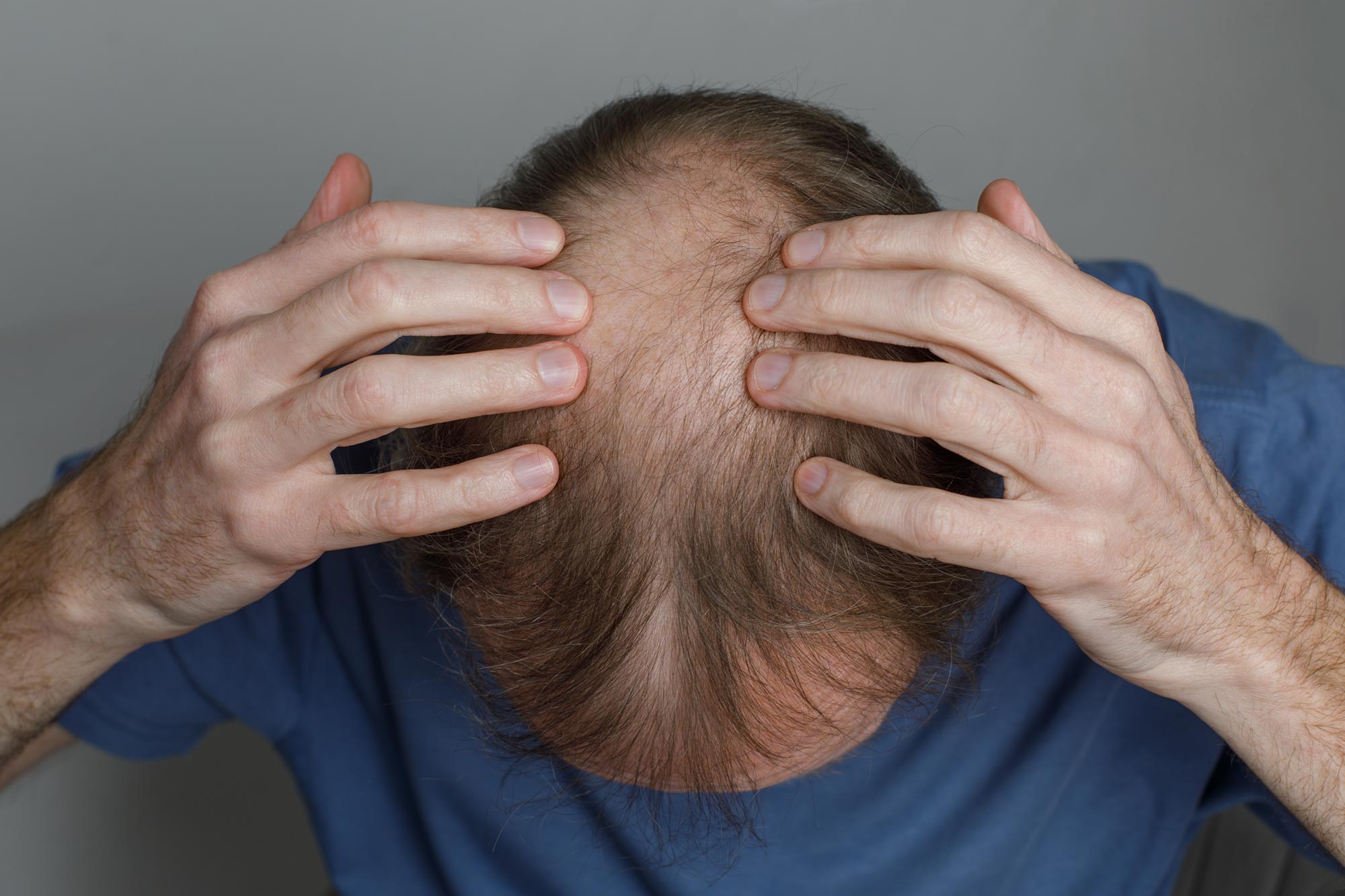 Ancient Chinese Herb Offers Hope for Common Hair Loss Treatment