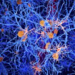 Scientists Discover Preventable Early Stage of Alzheimer’s