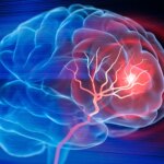 Scientists Create IV Therapy to Repair Brain Post-Stroke