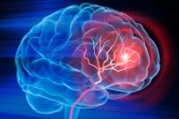 Scientists Create IV Therapy to Repair Brain Post-Stroke