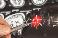 New Cellular Target May Revolutionize Alzheimer’s Treatment