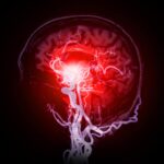 Tiny Clots: A Key Factor in Understanding Alzheimer’s Disease