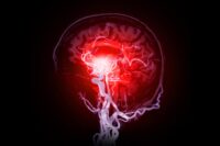 Tiny Clots: A Key Factor in Understanding Alzheimer’s Disease