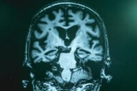 Scientists Uncover Widespread Chemical Disruptions in Alzheimer’s