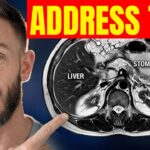 How Visceral Fat Affects Your Brain and How to Stop It