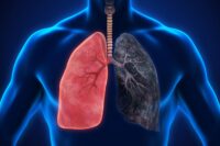 How Aging Lungs Elevate Mild Infections to Severe Risks