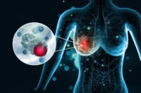 Scientists Identify Molecular “Switch” to Halt Breast Cancer Spread