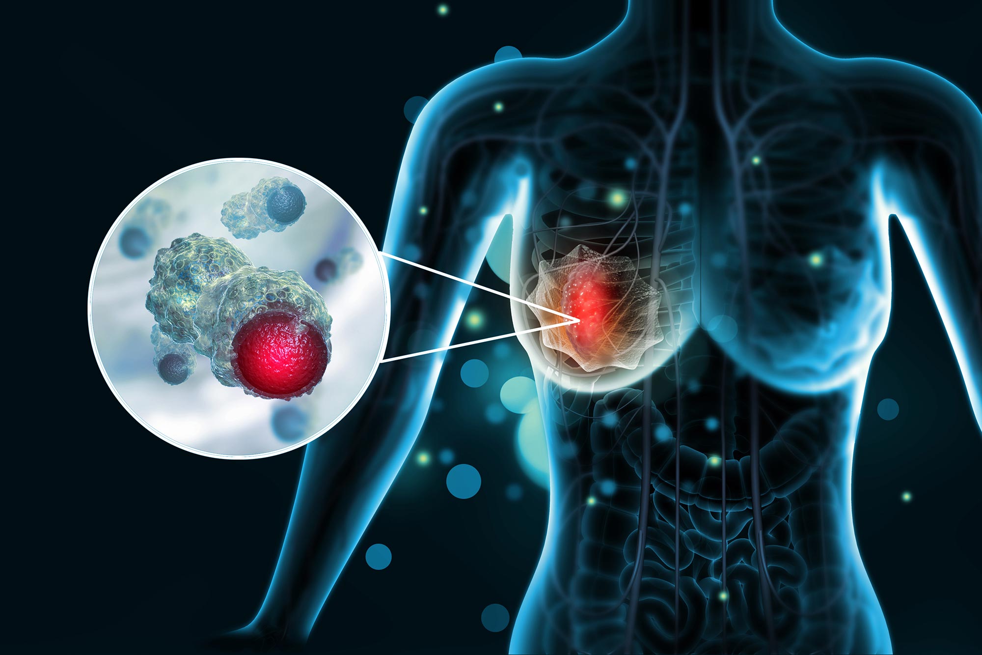 Scientists Identify Molecular “Switch” to Halt Breast Cancer Spread