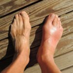 New Treatment Approach for Gout in Specific Patients Discovered